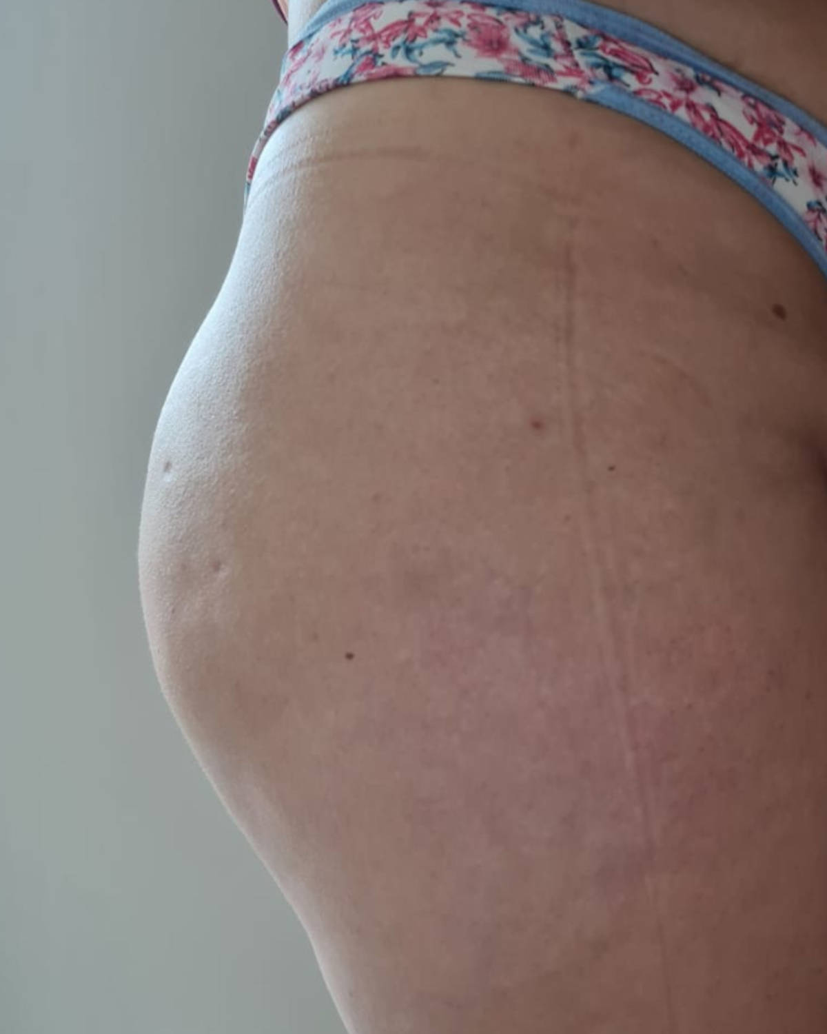 Antes - Bioestimulador de Colágeno Glúteo