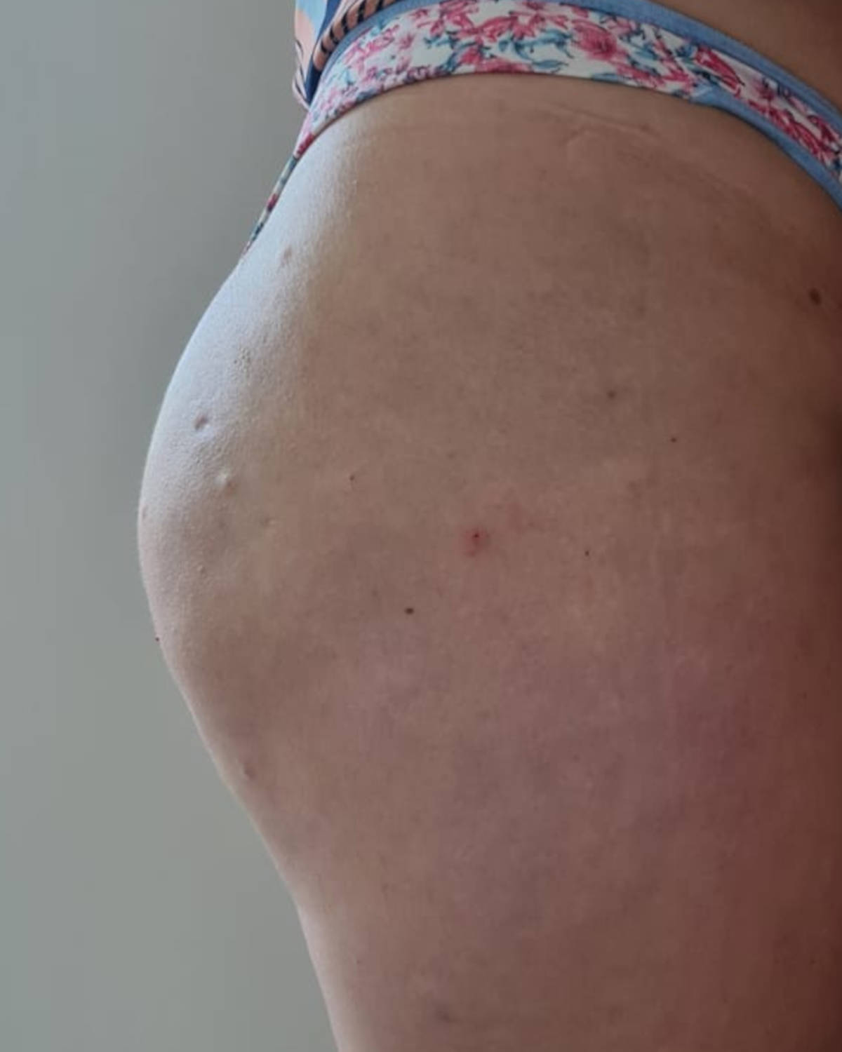 Depois - Bioestimulador de Colágeno Glúteo