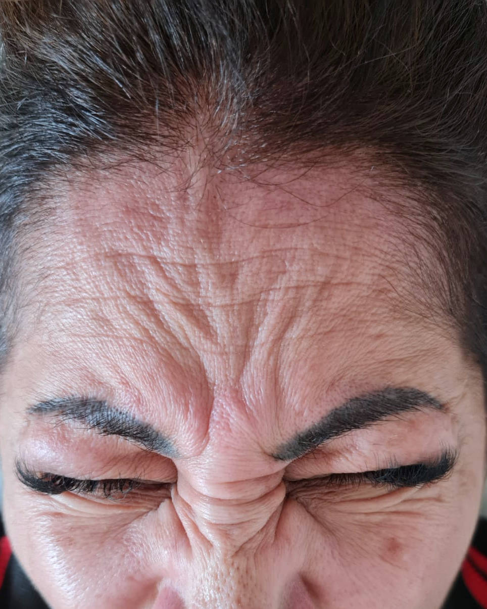 Antes - Toxina Botulínica