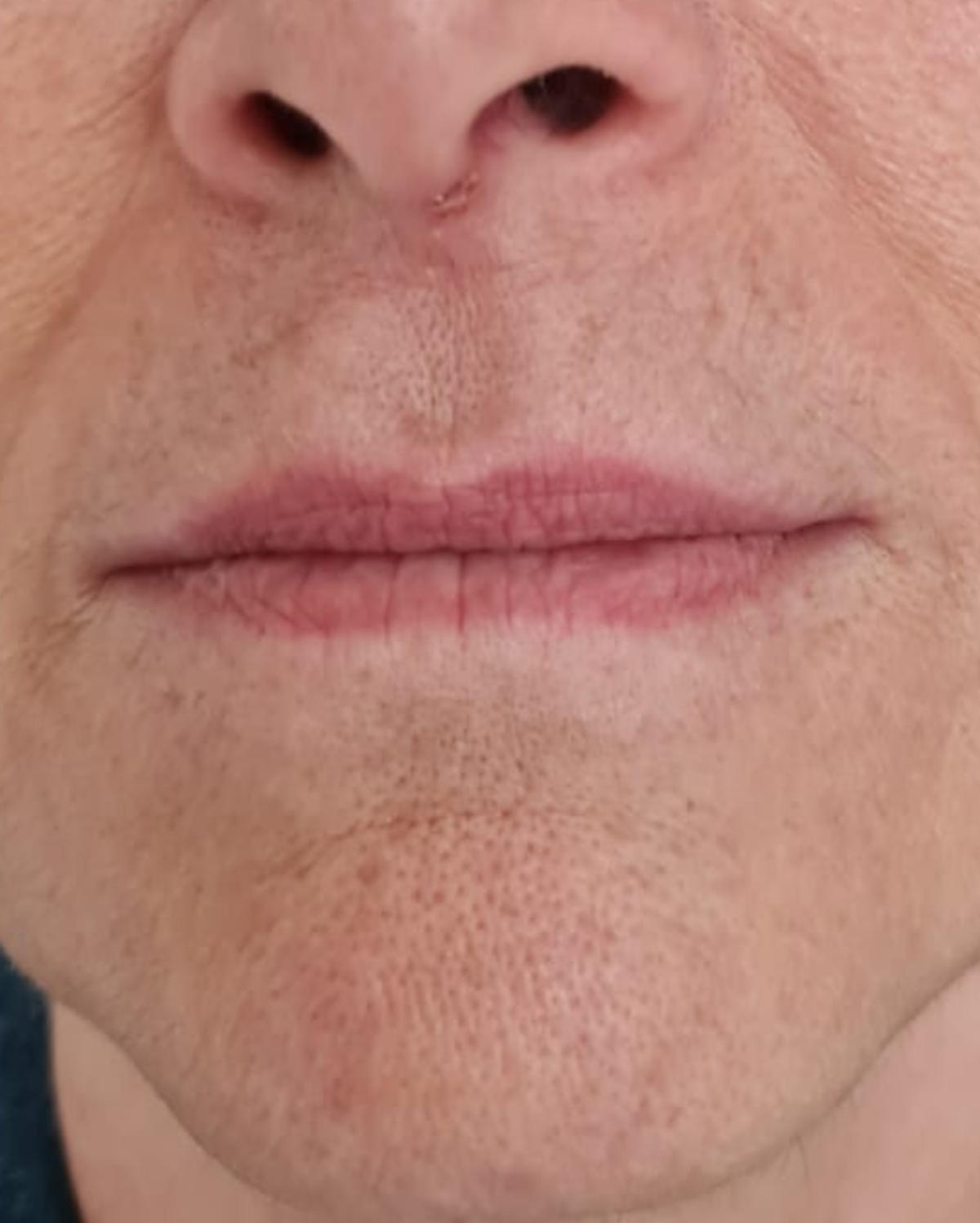 Antes - Preenchimento Labial