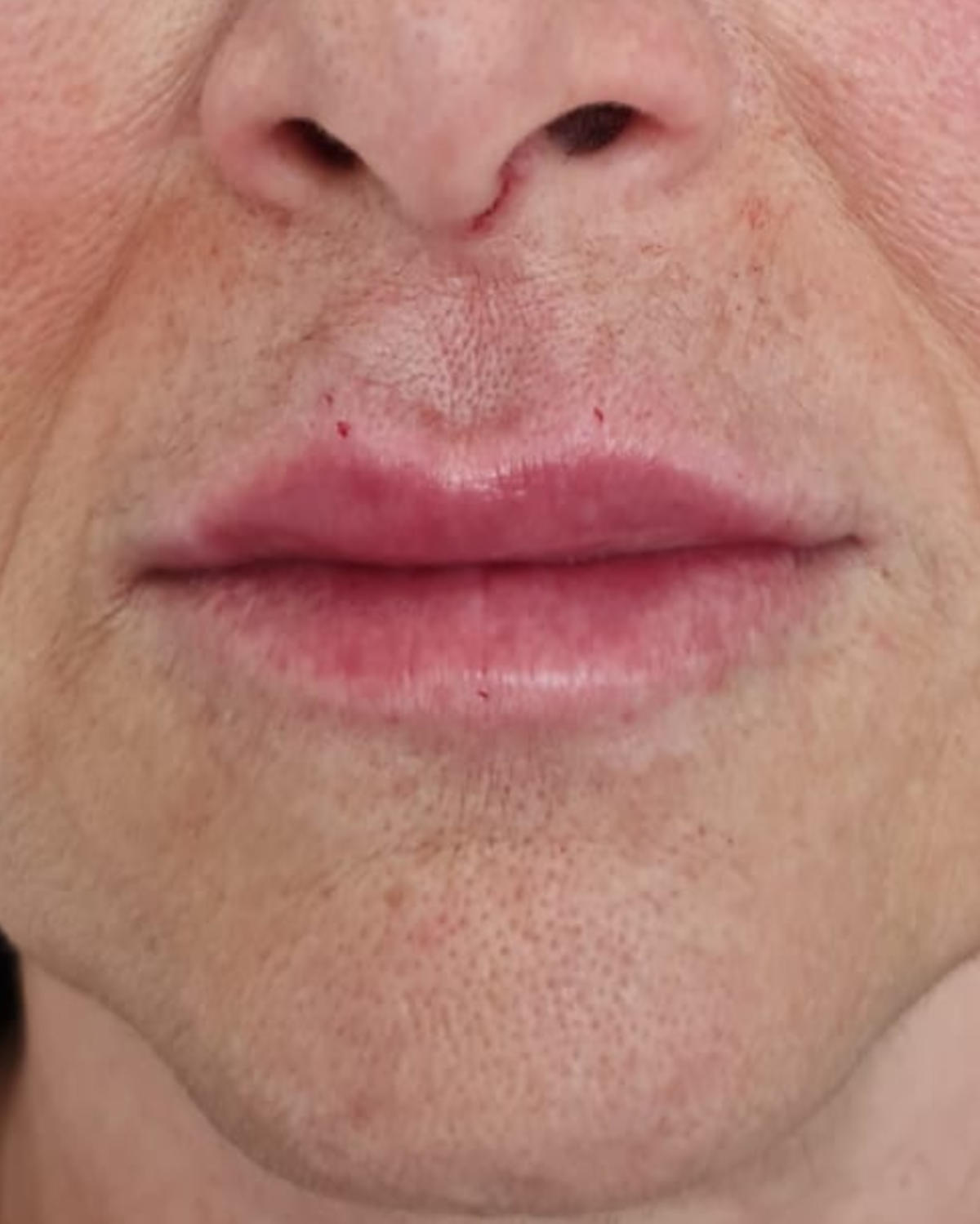 Depois - Preenchimento Labial