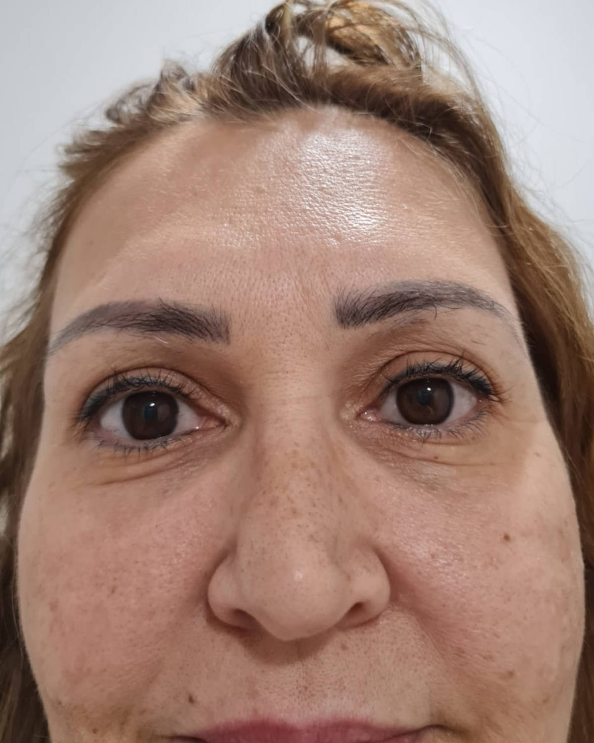 Antes - Preenchimento de Olheiras