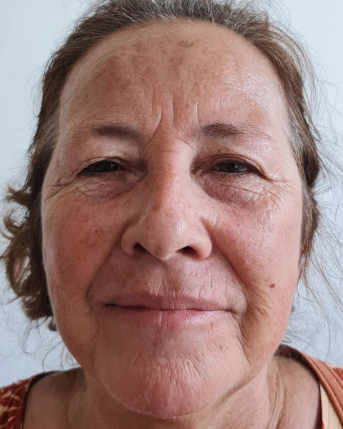 Antes - Peeling
