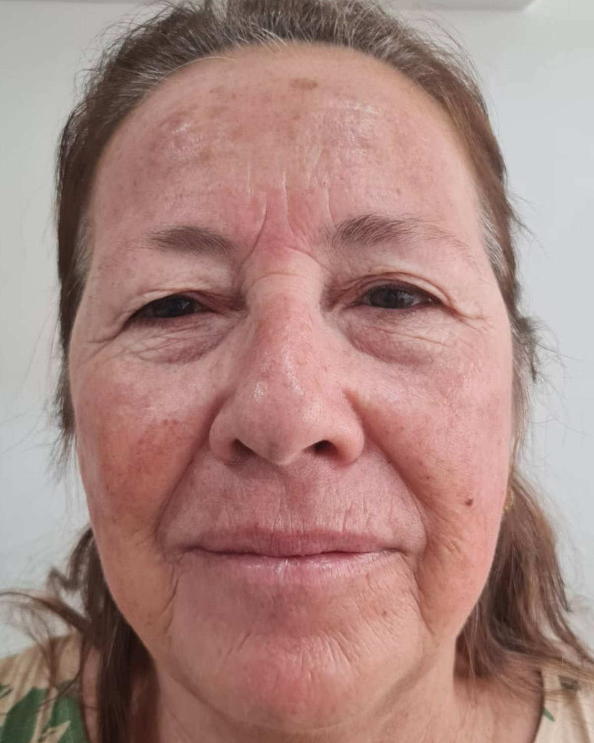 Depois - Peeling