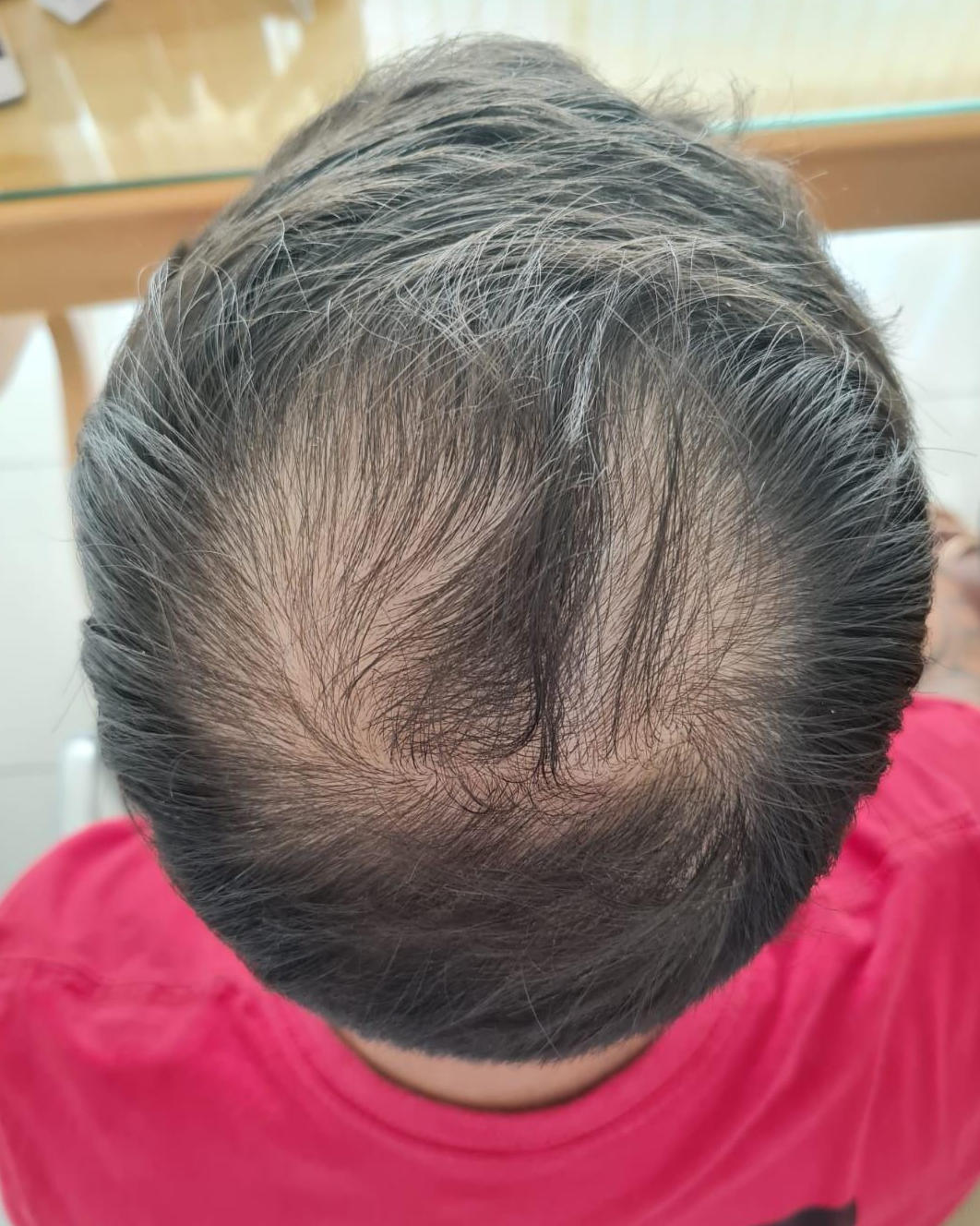 Antes - Tricologia