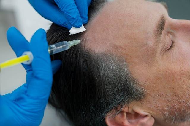 Intradermoterapia Capilar